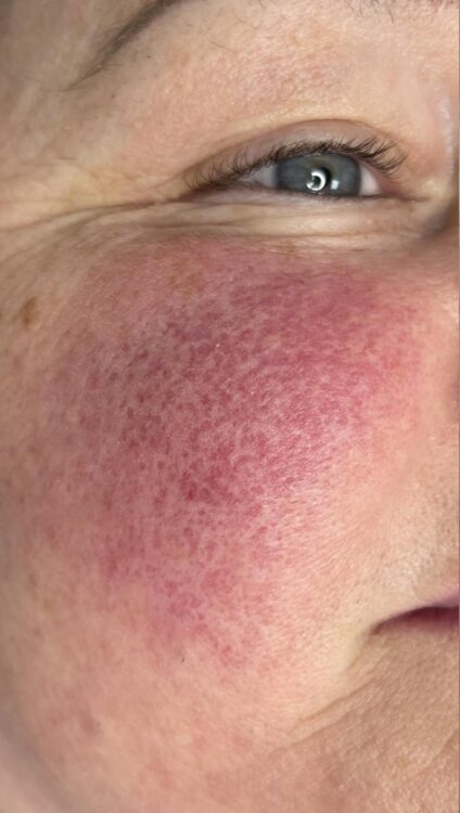 before and after ipl vascular a nu u beauty and brows 1