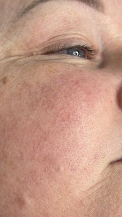 before and after ipl vascular a nu u beauty and brows 2