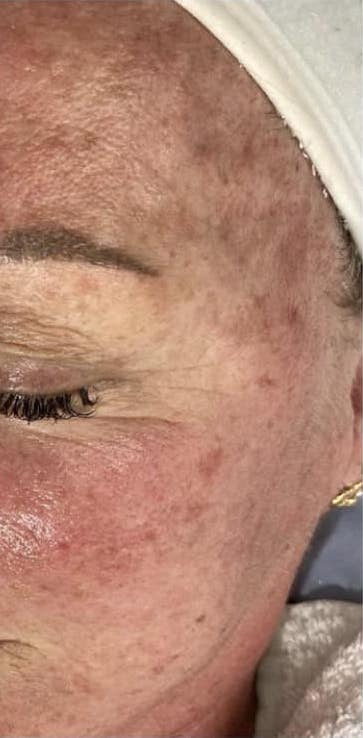 before and after microdermabrasion 2 the natural glow bar 1