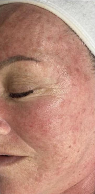 before and after microdermabrasion 2 the natural glow bar 2