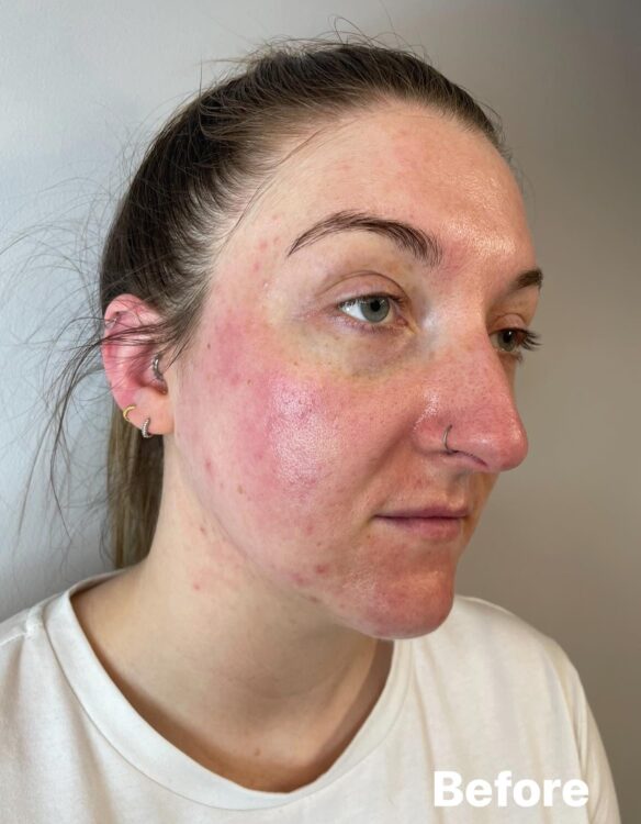 before and after microdermabrasion beaute 1