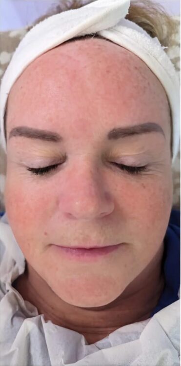 before and after microdermabrasion collagen lift glam beauty education 1