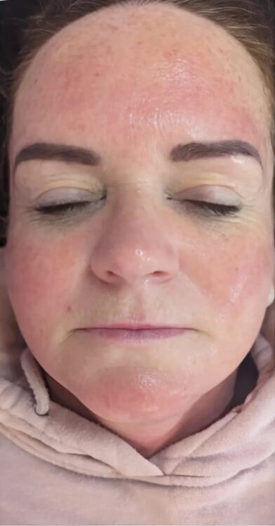 before and after microdermabrasion collagen lift glam beauty education 2