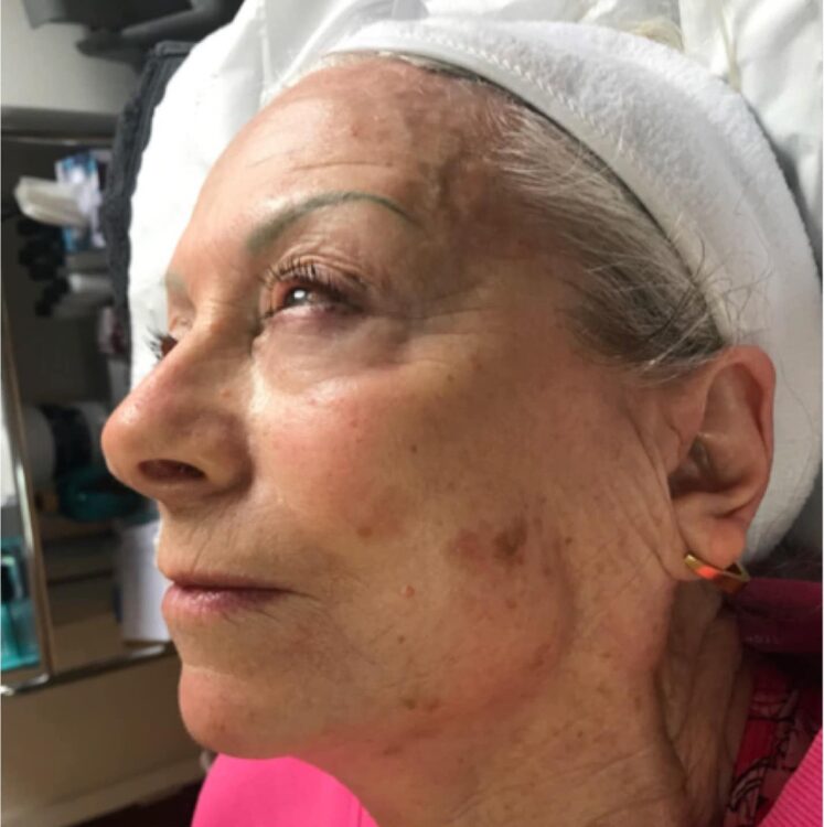 before and after microdermabrasion emily's beauty room 1