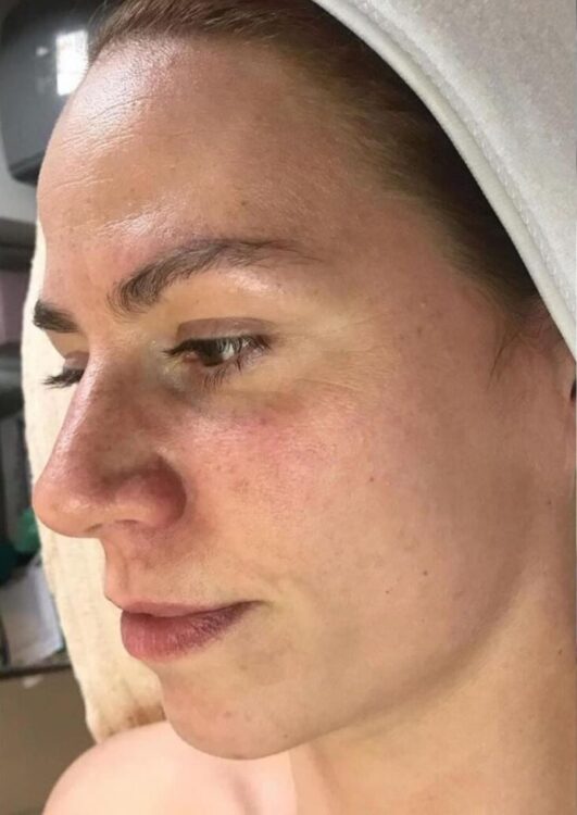 before and after microdermabrasion emily's beauty room 1