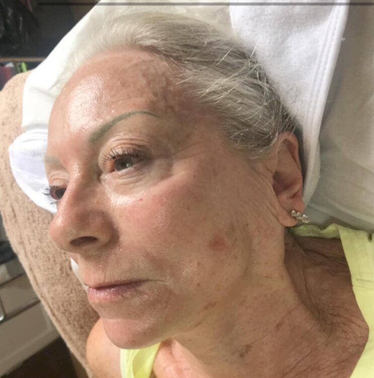 before and after microdermabrasion emily's beauty room 2