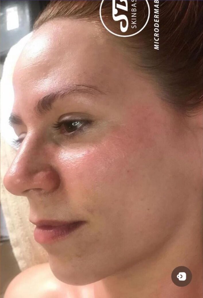 before and after microdermabrasion emily's beauty room 2
