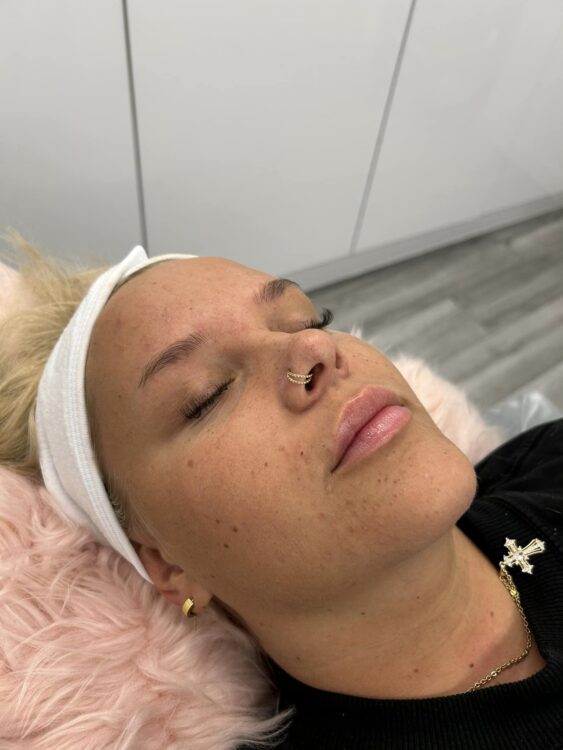 before and after microdermabrasion flawless aesthetics 1