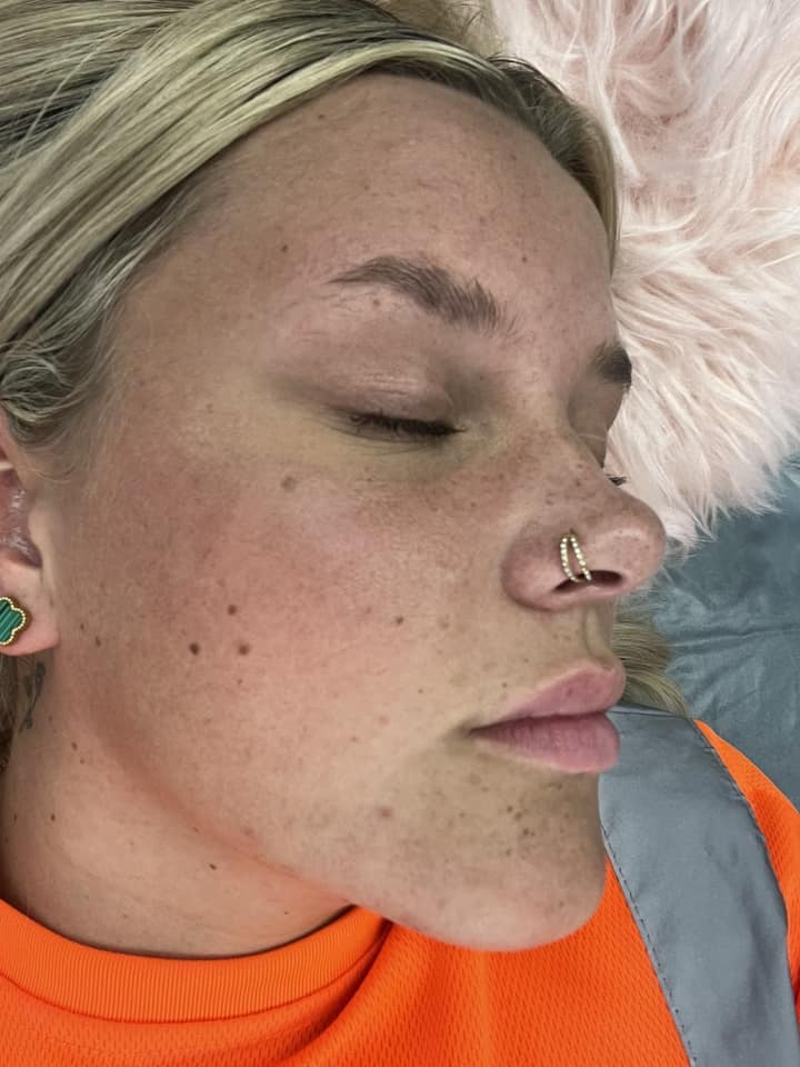 before and after microdermabrasion flawless aesthetics 2