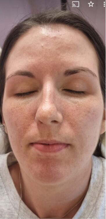 before and after microdermabrasion hydro glam beauty education 1
