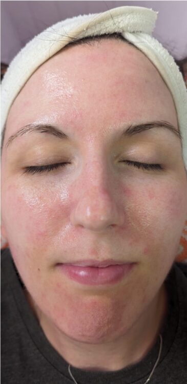 before and after microdermabrasion hydro glam beauty education 2