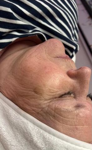 before and after microdermabrasion ink and beauty by michelle 1