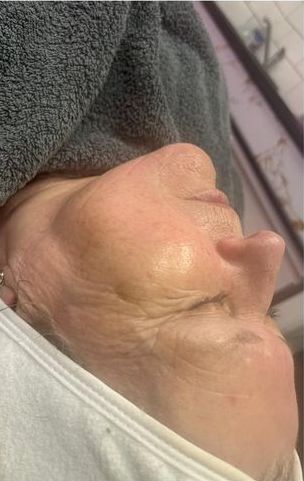 before and after microdermabrasion ink and beauty by michelle 2