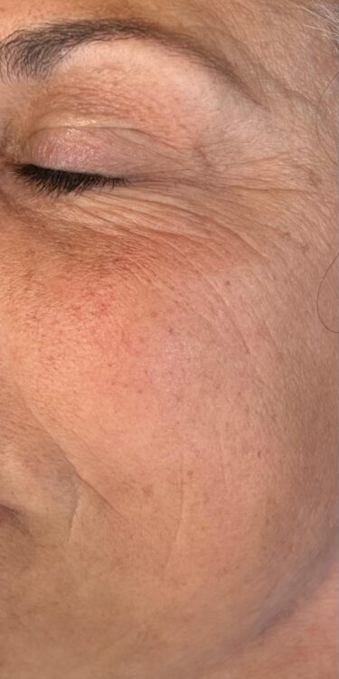 before and after microdermabrasion polished up by leigh 1