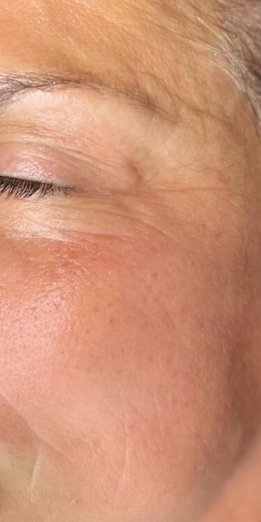 before and after microdermabrasion polished up by leigh 2