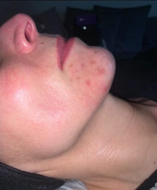 before and after microdermabrasion the blissful beauty company 1