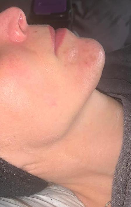 before and after microdermabrasion the blissful beauty company 2