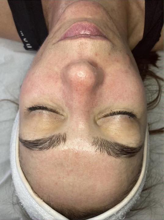 before and after microdermabrasion the natural glow bar 1