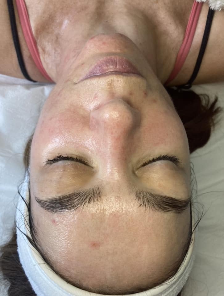 before and after microdermabrasion the natural glow bar 2