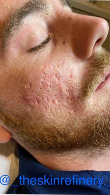 before and after microdermabrasion the skin refinery 1