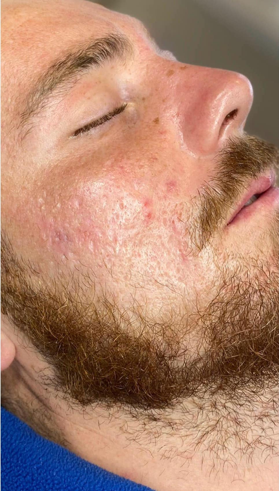 before and after microdermabrasion the skin refinery 2