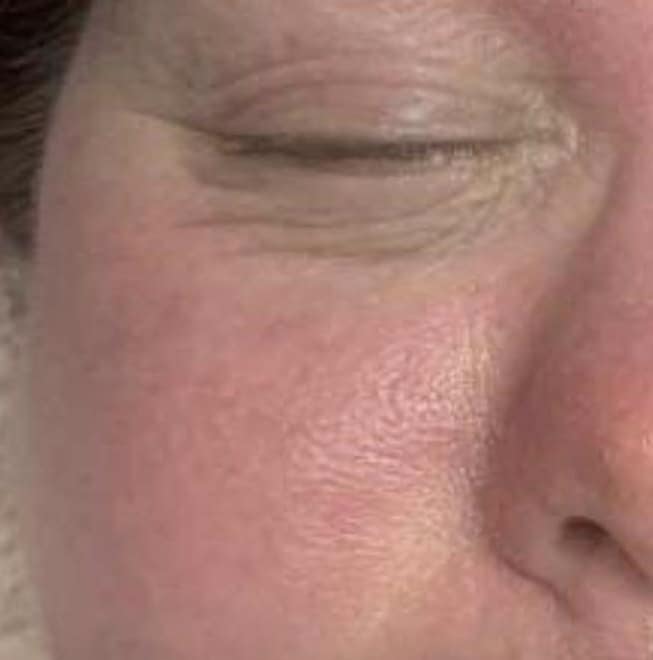 before and after microdermabrasion twinkle with glamour 1