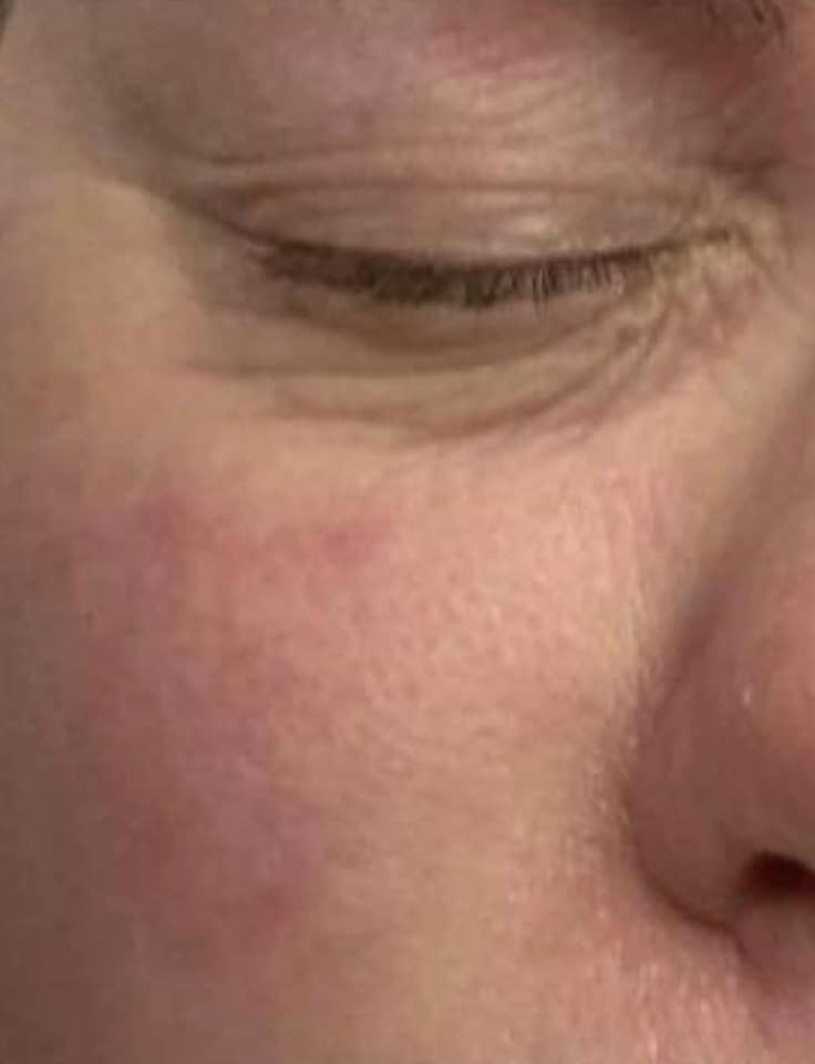 before and after microdermabrasion twinkle with glamour 2