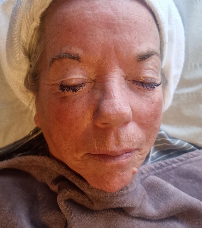 before and after skinbase hydro massage2u 1