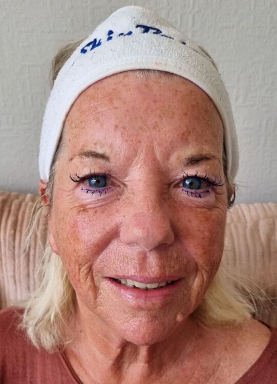 before and after skinbase hydro massage2u 2