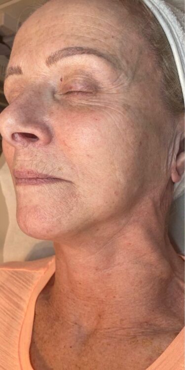 before and after skinbase hydro the hive 1