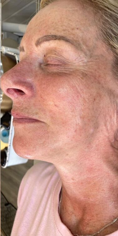 before and after skinbase hydro the hive 2
