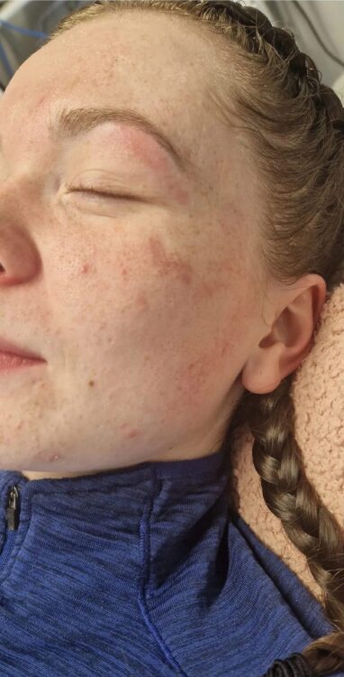 before and after skinbase hydro vicky's beauty cove 1