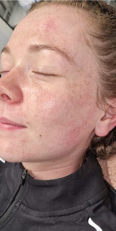 before and after skinbase hydro vicky's beauty cove 2