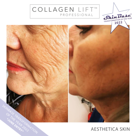 Must See Collagen Lift Transformation Must See Collagen Lift Transformation