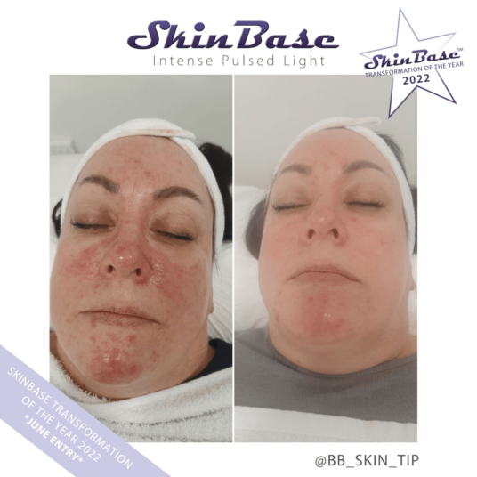 BBSKINTIP BBSKINTIP