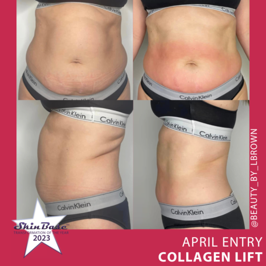 April transformation entries April transformation entries radio frequency tummy transformation