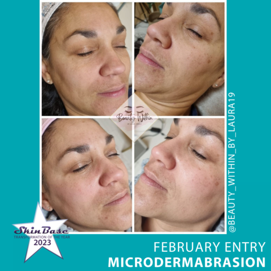 microdermabrasion facial
