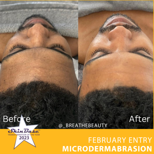 microdermabrasion facial
