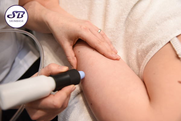 Microdermabrasion for keratosis pilaris
