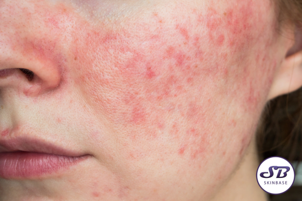 rosacea