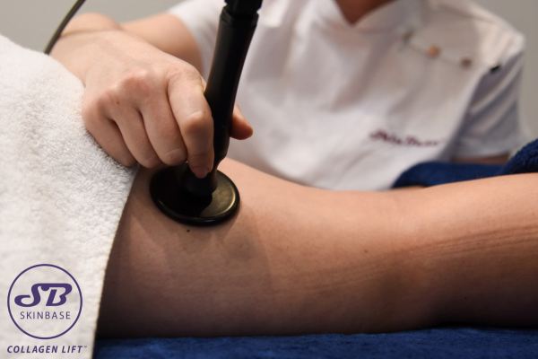 radio frequency skin treatment