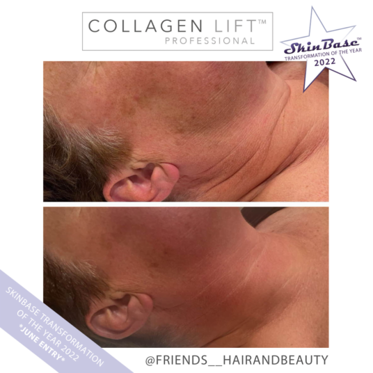 Must See Collagen Lift Transformation Must See Collagen Lift Transformation