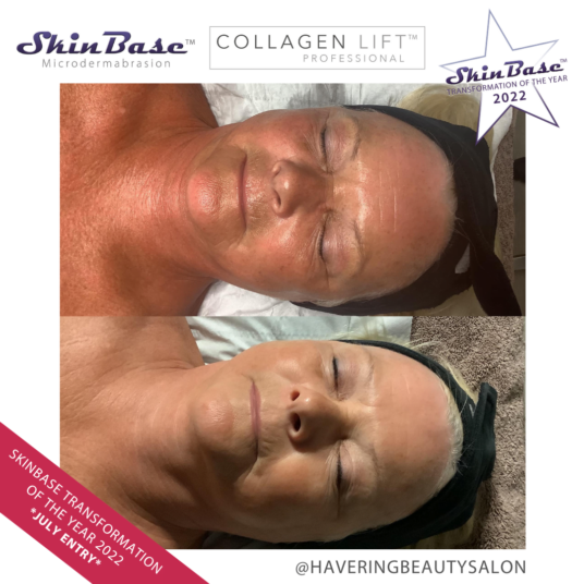 havering collagen lift facial