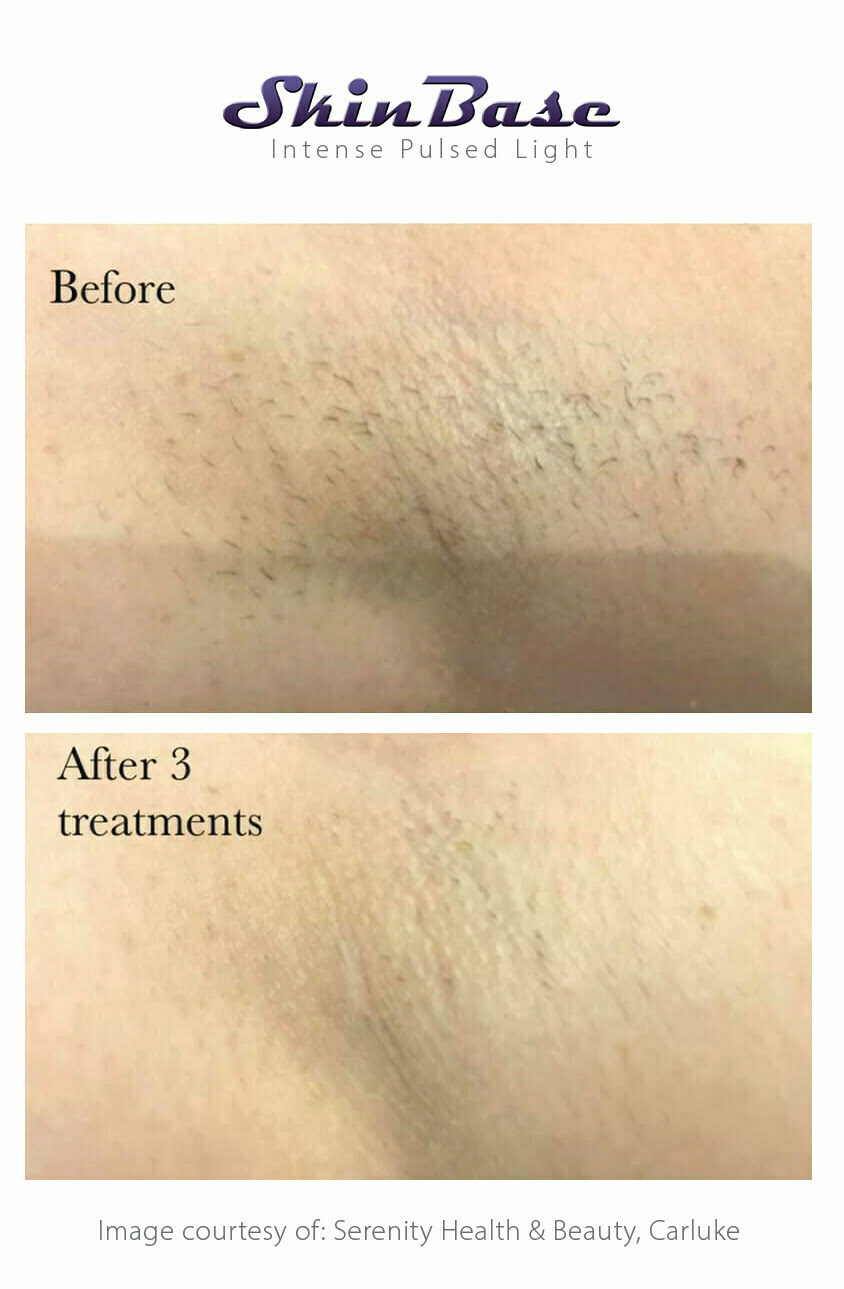 IPL-after-3-hair