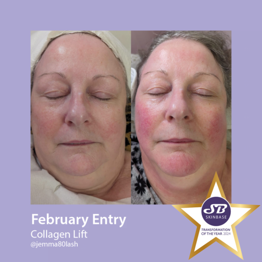 February Collagen Lift transformations Hollywood beauty February Collagen Lift transformations Hollywood beauty