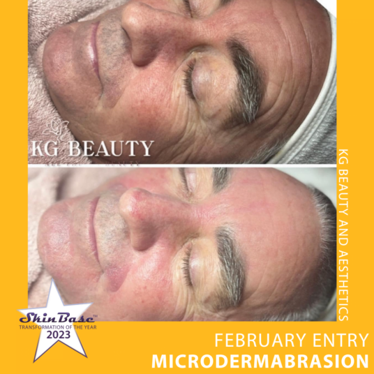 microdermabrasion facial