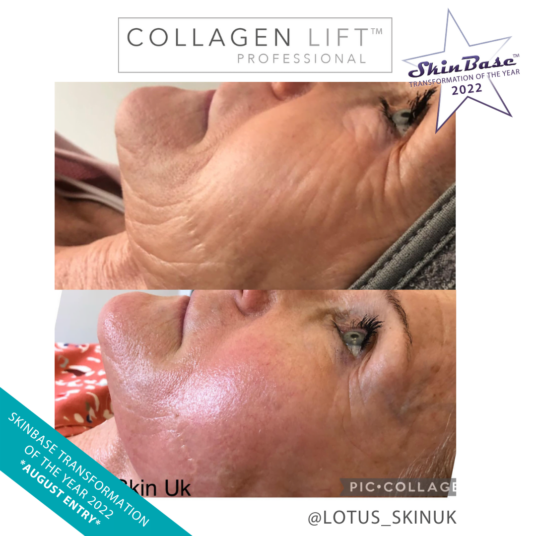 LOTUSSKINUK LOTUSSKINUK Collagen Lift facial Transformation