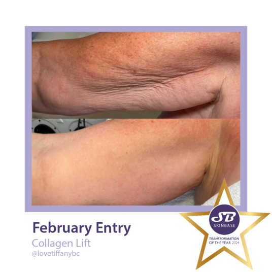 February Collagen Lift transformations love Tiffany February Collagen Lift transformations love Tiffany