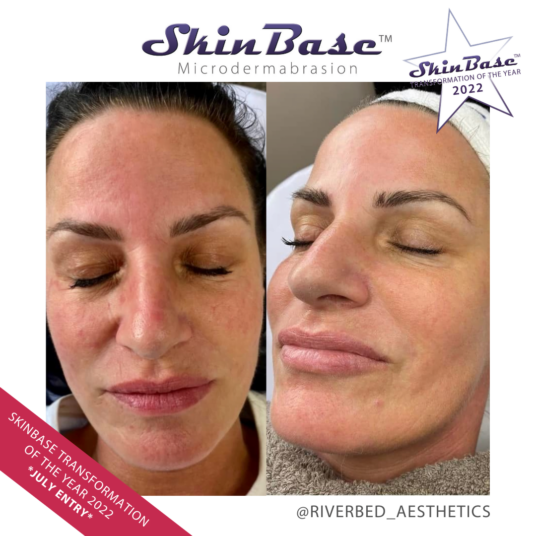 MICRODERMABRASION RIVERBEDAESTHETICS