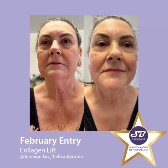 February Collagen Lift transformations the beauty cabin February Collagen Lift transformations the beauty cabin
